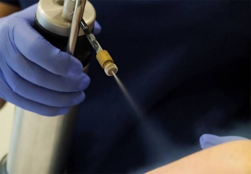 Mụn cóc có ngứa không? 5 - 5 Phương pháp áp lạnh trị mụn cóc là bác sĩ sẽ phun ni tơ lỏng vào nốt mụn nhiều lần kích thích bong gốc mụn cóc.