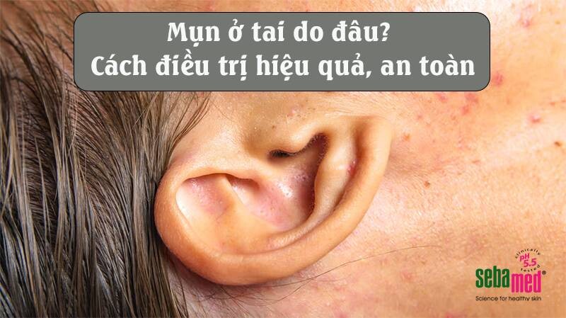 Mụn ở tai do đâu? Cách điều trị hiệu quả, an toàn