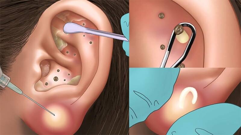 Mụn ở tai do đâu? Cách điều trị hiệu quả, an toàn 4 - 4 Tìm hiểu Có nên nặn mụn tai không?