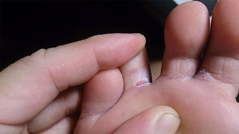 Nấm Candida da ở vị trí kẽ ngón chân.