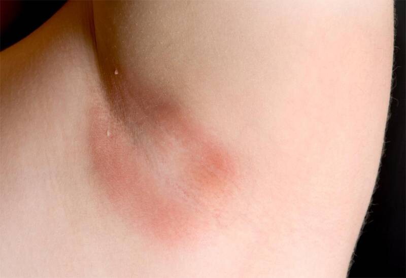 Nấm Candida ở vùng da có nếp gấp.
