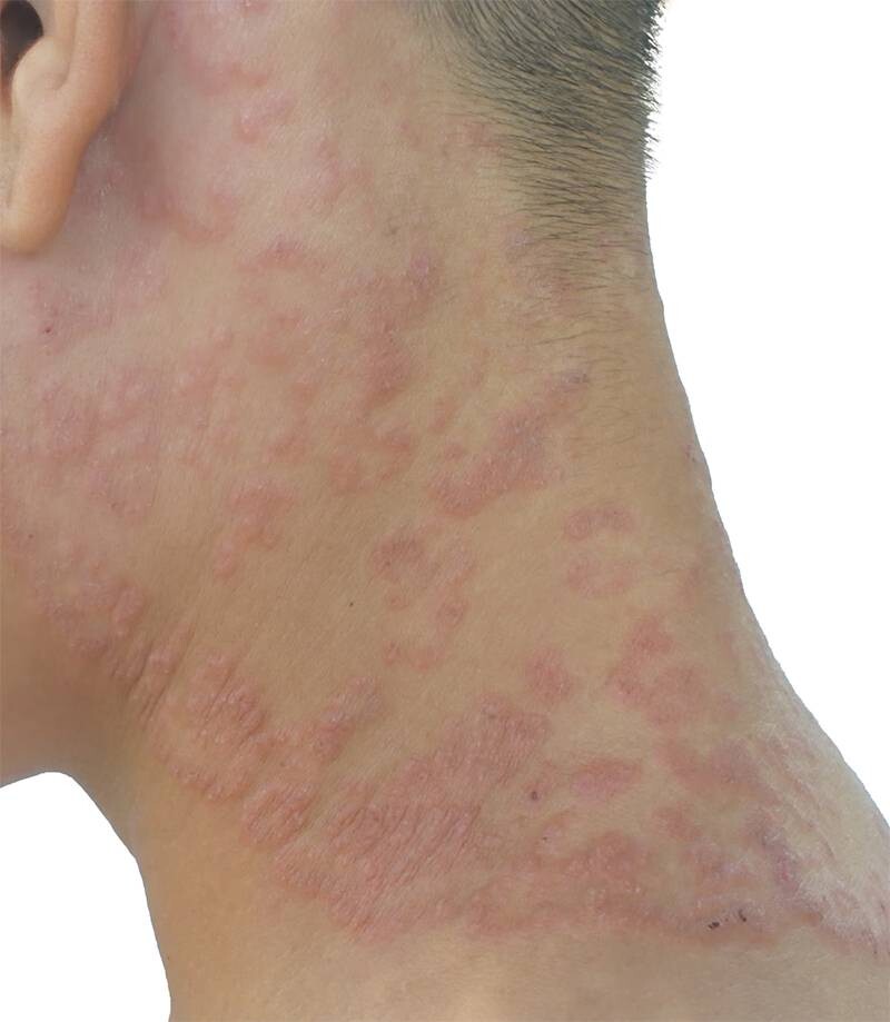 Hình ảnh nhiễm nấm  Candida lan rộng.