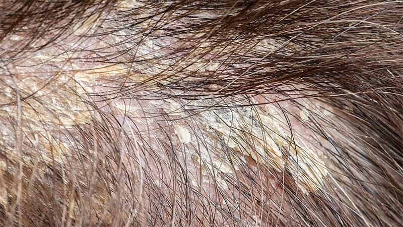 Nấm da đầu: Nguyên nhân, dấu hiệu, điều trị và phòng ngừa chuẩn y khoa 2 - 2 Nguyên nhân bị nấm da đầu phổ biến thường gặp.