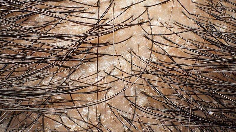 Nấm da đầu: Nguyên nhân, dấu hiệu, điều trị và phòng ngừa chuẩn y khoa 5 - 5 Nấm da đầu có tự khỏi không?