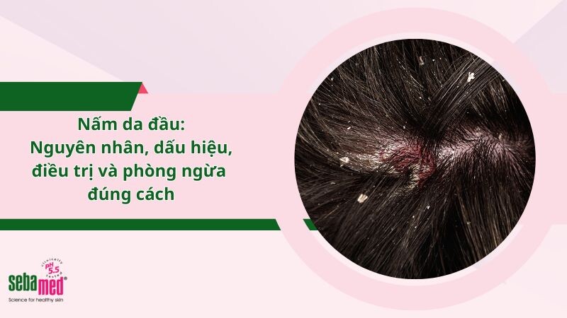 Nấm da đầu: Nguyên nhân, dấu hiệu, điều trị và phòng ngừa chuẩn y khoa