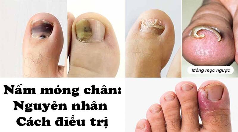 Nấm móng chân: Nguyên nhân, cách điều trị và phòng ngừa hiệu quả