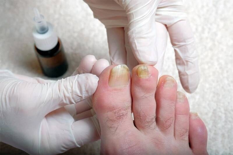 Sử dụng thuốc bôi ngoài để điều trị nấm móng chân.
