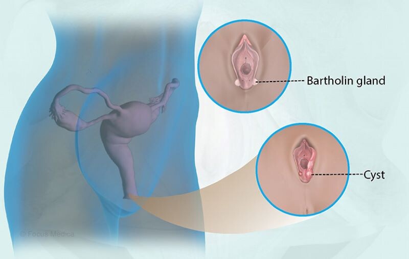 Môi lớn bị sưng 1 bên: Nguyên nhân và cách xử lý nhanh 2 - 2 Môi lớn bị sưng 1 bên do U nang tuyến Bartholin