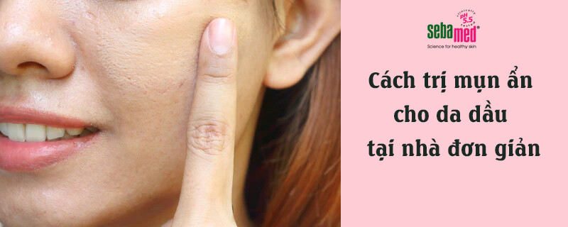 6 Cách trị mụn ẩn cho da dầu hiệu quả, nhanh chóng 2 - 2 Cách trị mụn ẩn cho da dầu hiệu quả, nhanh chóng