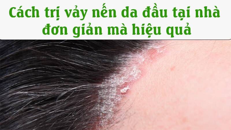 8 cách trị vảy nến da đầu tại nhà đơn giản mà hiệu quả