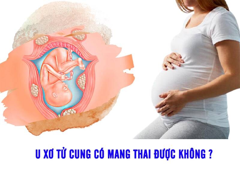 U xơ tử cung có mang thai được không? Câu trả lời từ chuyên gia