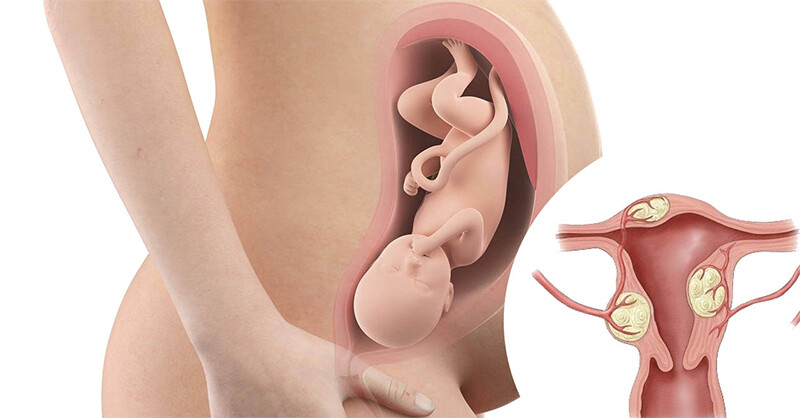 Bị U xơ tử cung mang thai được không? Tại sao u xơ tử cung lại ảnh hưởng tới khả năng thụ thai?