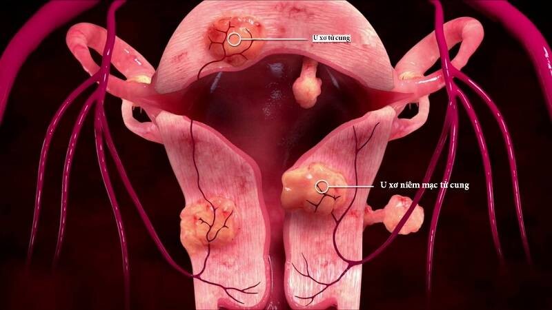 Bị u xơ tử cung có thể sẽ có biến chứng khiến cơ thể bạn thiếu máu