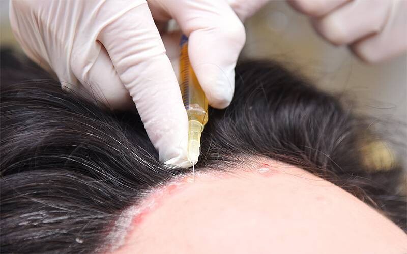 Vảy nến da đầu có chữa được không?