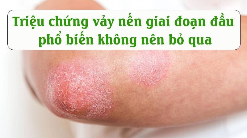 Triệu chứng vảy nến giai đoạn đầu phổ biến không nên bỏ qua 2 - 2 Triệu chứng vảy nến giai đoạn đầu phổ biến không nên bỏ qua.