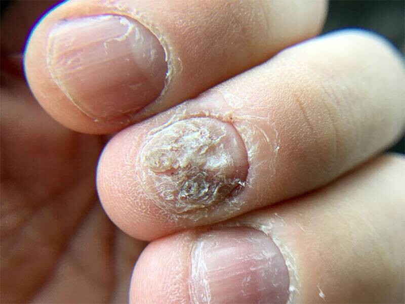 Triệu chứng vảy nến giai đoạn đầu phổ biến không nên bỏ qua 5 - 5 Hình ảnh bệnh vảy nến móng tay.