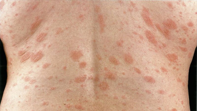 Vảy nến hồng là gì? Phân biệt vảy phấn hồng và vảy nến chi tiết 3 - 3 Tìm hiểu Bệnh vảy nến hồng có nguy hiểm không?