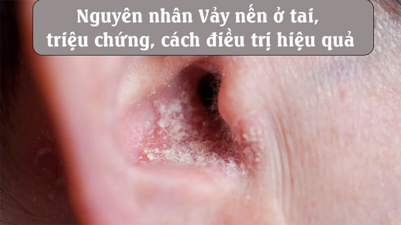 Vảy nến ở tai: Nguyên nhân, triệu chứng, cách điều trị hiệu quả
