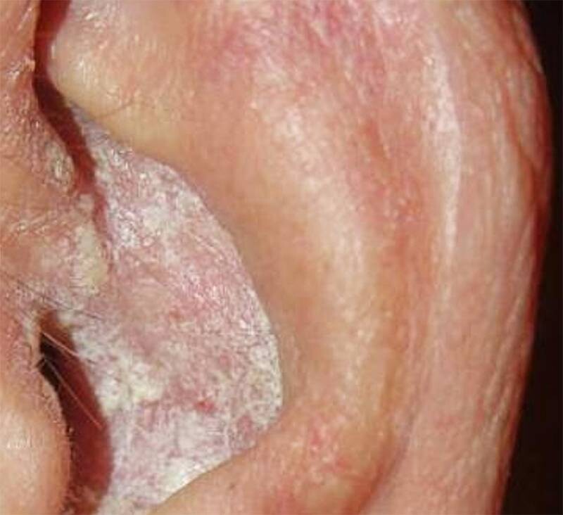 Vảy nến ở tai: Nguyên nhân, triệu chứng, cách điều trị hiệu quả 2 - 2 Triệu chứng bệnh vảy nến ở tai.