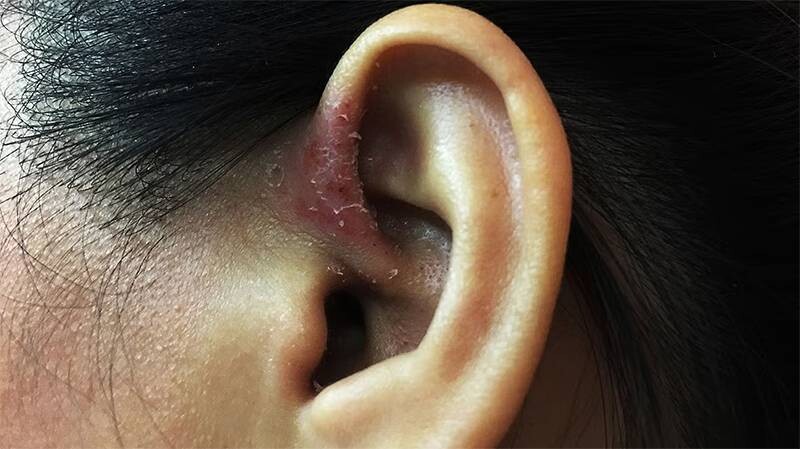 Vảy nến ở tai: Nguyên nhân, triệu chứng, cách điều trị hiệu quả 4 - 4 Cách phòng ngừa tái phát vảy nến ở tai.