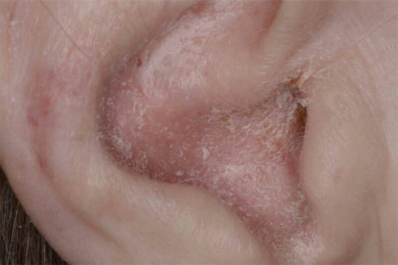 Vảy nến ở tai: Nguyên nhân, triệu chứng, cách điều trị hiệu quả 5 - 5 Bệnh vảy nến có lây không?