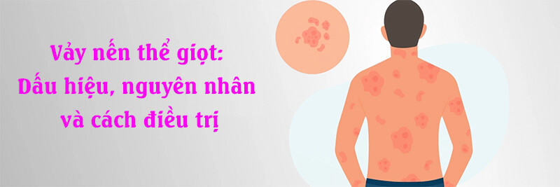 Vảy nến thể giọt: Dấu hiệu, nguyên nhân và cách điều trị
