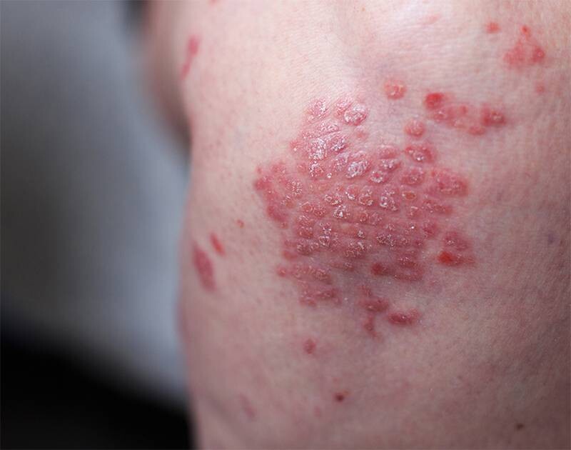 Vảy nến thể giọt: Dấu hiệu, nguyên nhân và cách điều trị 1 - 1 Tìm hiểu Bệnh vảy nến thể giọt là gì?