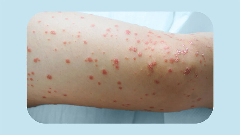 Vảy nến thể giọt: Dấu hiệu, nguyên nhân và cách điều trị 3 - 3 Vảy nến thể giọt từ giai đoạn nhẹ có thể diễn biến trở nặng lan sang nhiều vùng cơ thể.