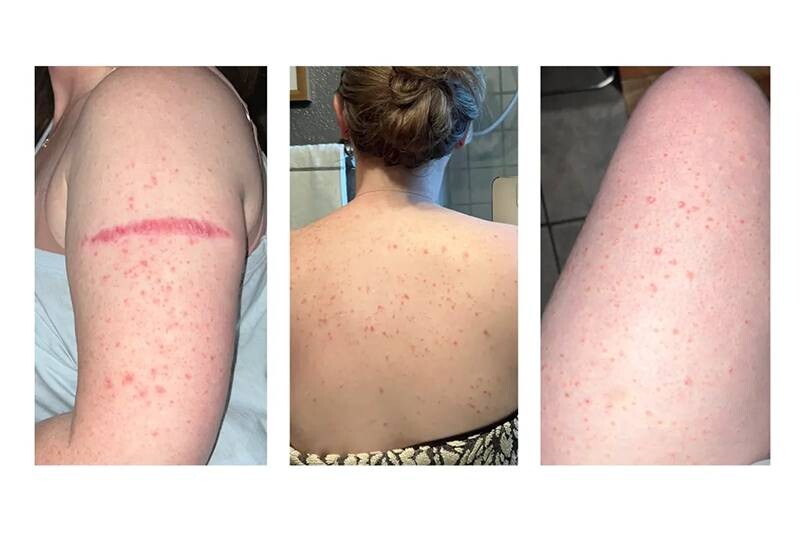 Vảy nến thể giọt: Dấu hiệu, nguyên nhân và cách điều trị 4 - 4 Điều trị vảy nến thể giọt theo phác đồ điều trị để nhanh khỏi các triệu chứng của bệnh.