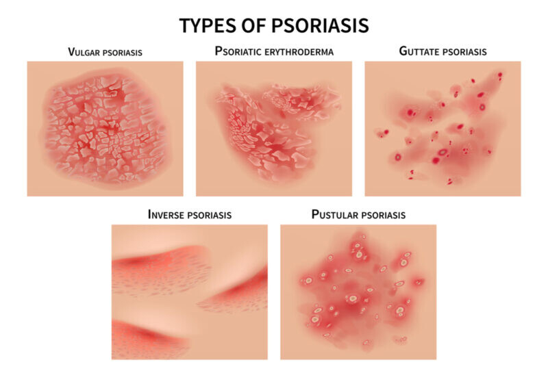 Phân biệt viêm da cơ địa và vảy nến khác nhau thế nào? 2 - 2 Tìm hiểu bệnh vảy nến là gì?