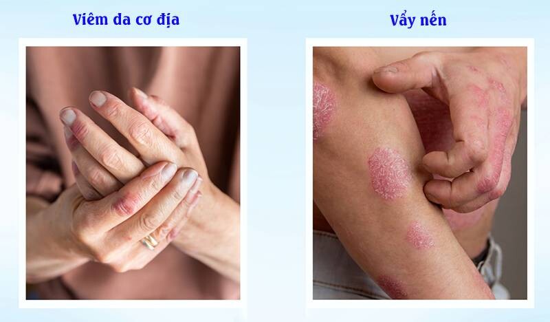 Phân biệt viêm da cơ địa và vảy nến khác nhau thế nào?