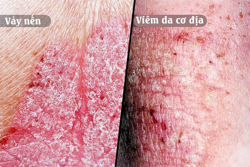 Phân biệt viêm da cơ địa và vảy nến khác nhau thế nào? 3 - 3 Phân biệt viêm da cơ địa và vảy nến qua các triệu chứng lâm sàng.