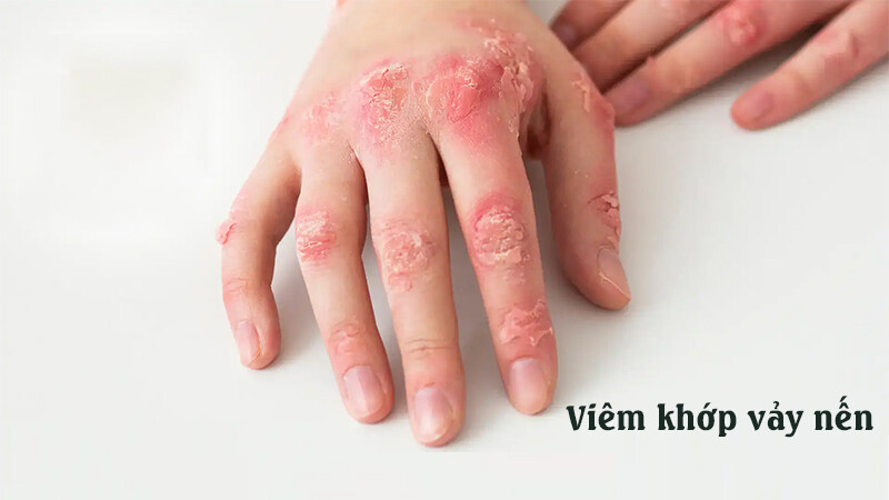 Viêm khớp vảy nến: Nguyên nhân, dấu hiệu và cách điều trị.