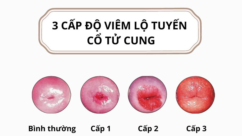 Viêm lộ tuyến độ 1 dấu hiệu và cách điều trị 2 - 2 Các cấp độ viêm lộ tuyến cổ tử cung.
