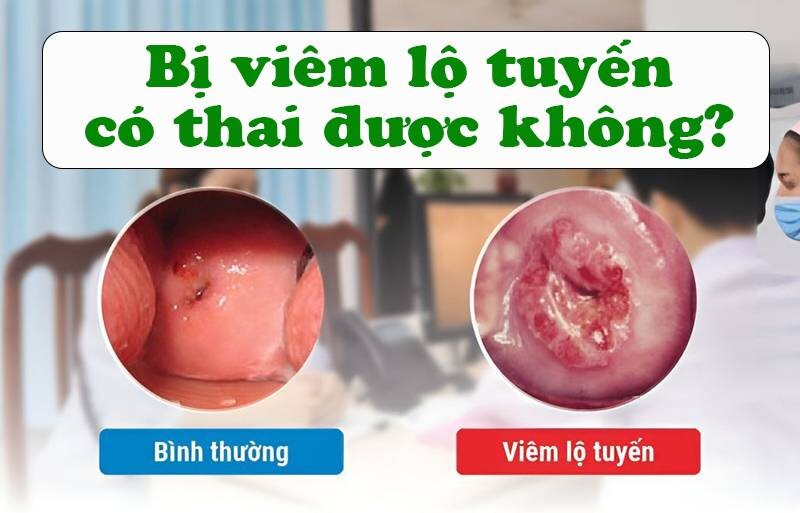 Viêm lộ tuyến có thai được không?