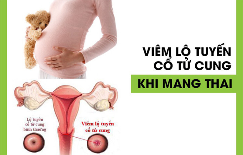 Viêm lộ tuyến có thai được không? 4 - 4 Viêm lộ tuyến cổ tử cung khi mang thai có ảnh hưởng thai nhi không?