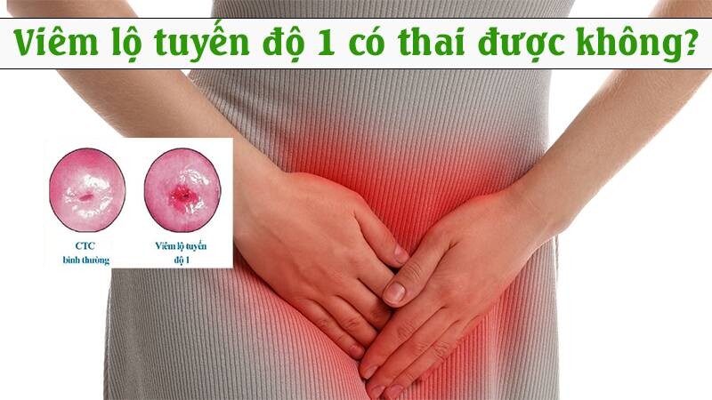 Viêm lộ tuyến độ 1 dấu hiệu và cách điều trị 8 - 8 Viêm lộ tuyến độ 1 có thai được không?