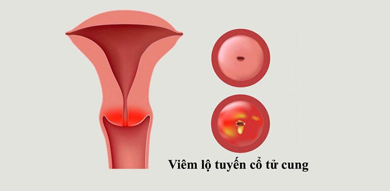 Viêm lộ tuyến: Nguyên nhân, triệu trứng, cách điều trị