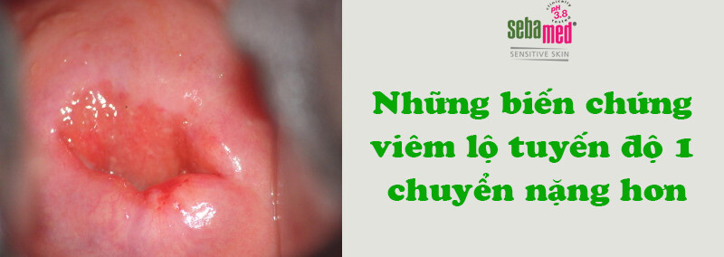 Viêm lộ tuyến độ 1 dấu hiệu và cách điều trị 9 - 9 Những biến chứng khi viêm lộ tuyến độ 1 chuyển nặng hơn.
