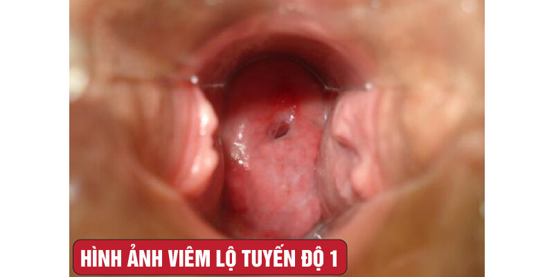 Viêm lộ tuyến độ 1 dấu hiệu và cách điều trị 5 - 5 Hình ảnh viêm lộ tuyến độ 1 qua thăm khám.