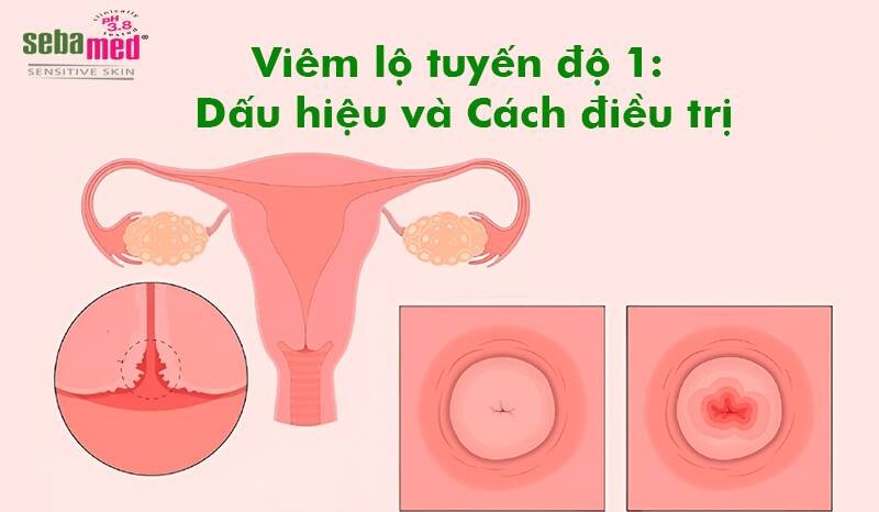 Viêm lộ tuyến độ 1 dấu hiệu và cách điều trị 4 - 4 Viêm lộ tuyến độ 1 dấu hiệu và cách điều trị