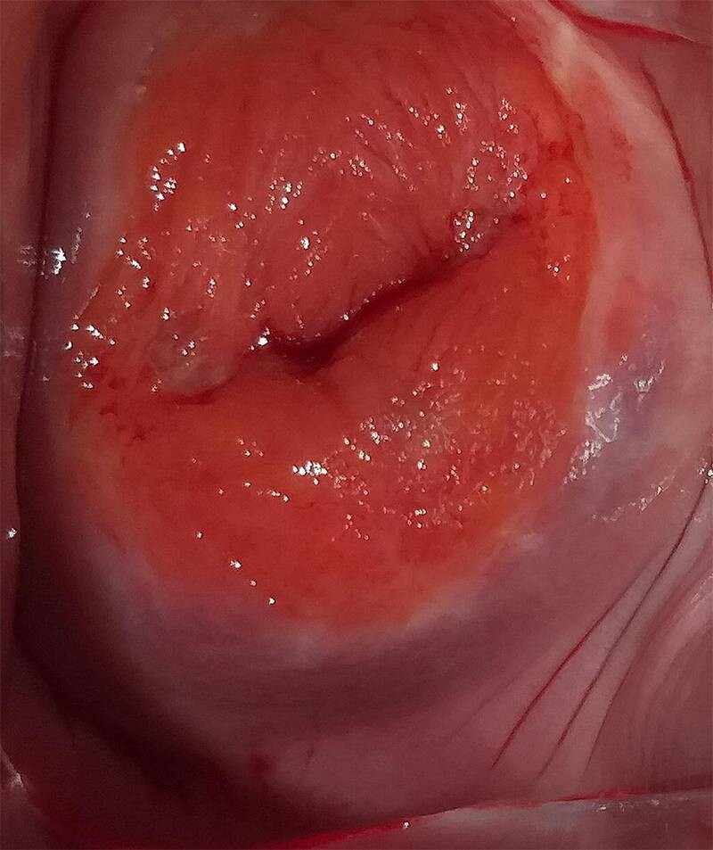 Viêm lộ tuyến độ 2 điều trị bao lâu khỏi? Có đốt được không? 1 - 1 Hình ảnh viêm lộ tuyến độ 2 chân thực.