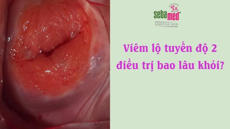 Viêm lộ tuyến độ 2 điều trị bao lâu khỏi? Có đốt được không? 5 - 5 Viêm lộ tuyến độ 2 điều trị bao lâu khỏi?