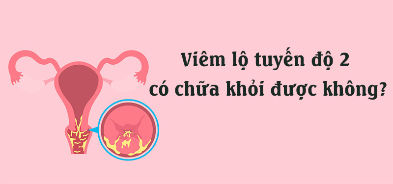 Viêm lộ tuyến độ 2 điều trị bao lâu khỏi? Có đốt được không? 6 - 6 Viêm lộ tuyến độ 2 có chữa khỏi được không?