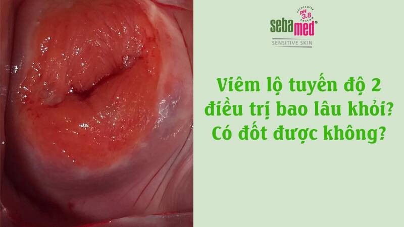 Viêm lộ tuyến độ 2 điều trị bao lâu khỏi? Có đốt được không?