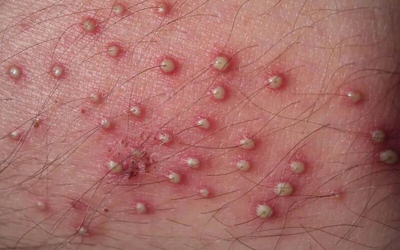 Vùng kín nổi mụn ngứa phải làm sao? Cách khắc phục