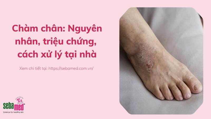 Chàm chân: Nguyên nhân, triệu chứng, cách giảm triệu chứng tại nhà