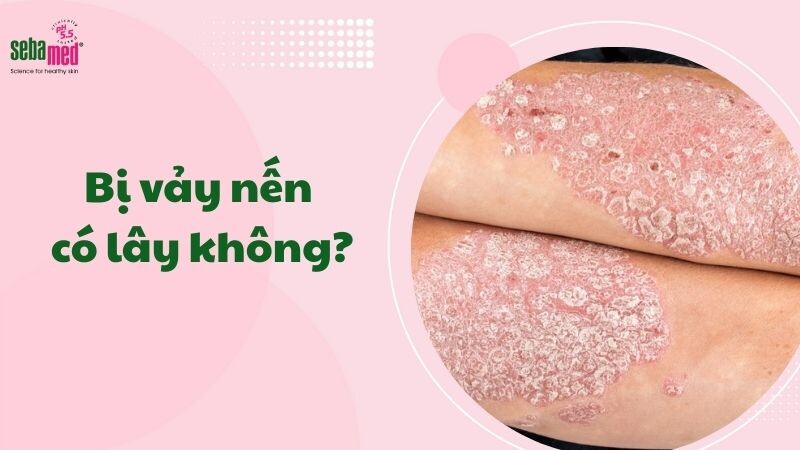 Bị vảy nến có lây không?