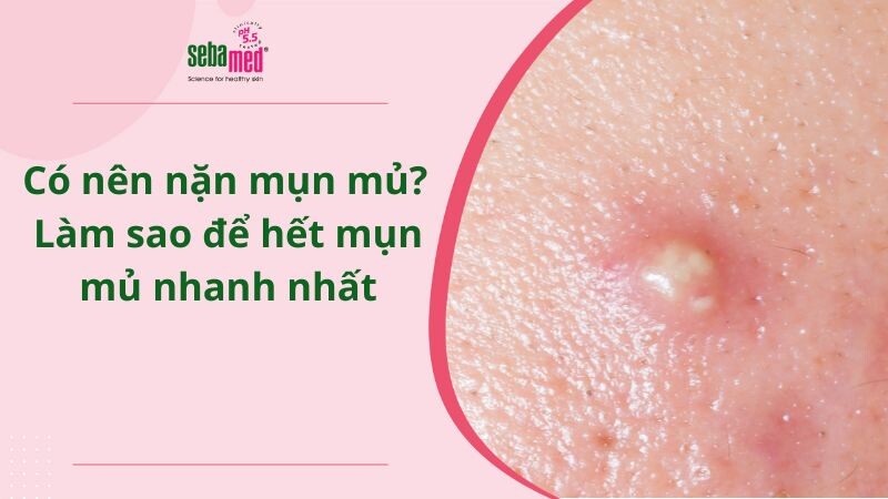 Có nên nặn mụn mủ không? Làm sao để hết mụn mủ nhanh nhất