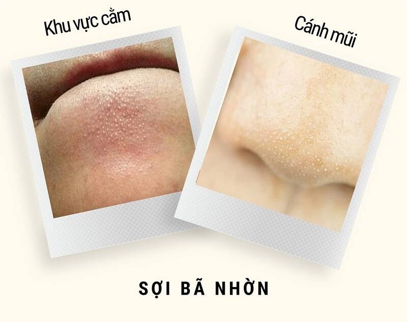 Sợi bã nhờn là gì? Tác dụng sợi bã nhờn trên làn da.